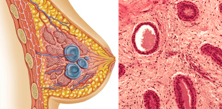 Fibroadenom Nedir? Fibroadenom Nedir?