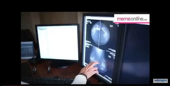 Memede Fark edilen her Kitle Kanser midir?