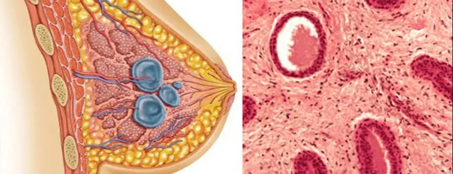 Fibroadenom Nedir? Fibroadenomlar kadınlarda her yaşta en sık rastlanan solid (katı, içi sıvı olmayan), selim (iyi huylu) meme tümörüdür. % 20 vakada sayıları birden fazladır.